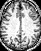 Axiale Aufnahme des Großhirns mit Kortexdarstellung