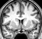 Zweite koronare Aufnahme mit Temporallappen und Hippocampus-Region